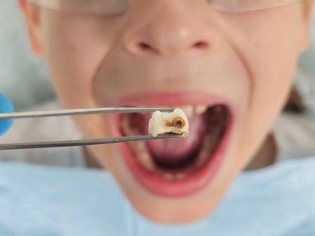 Best Emergency Treatment for Dental Infections or Abscesses in Waimalu, HI